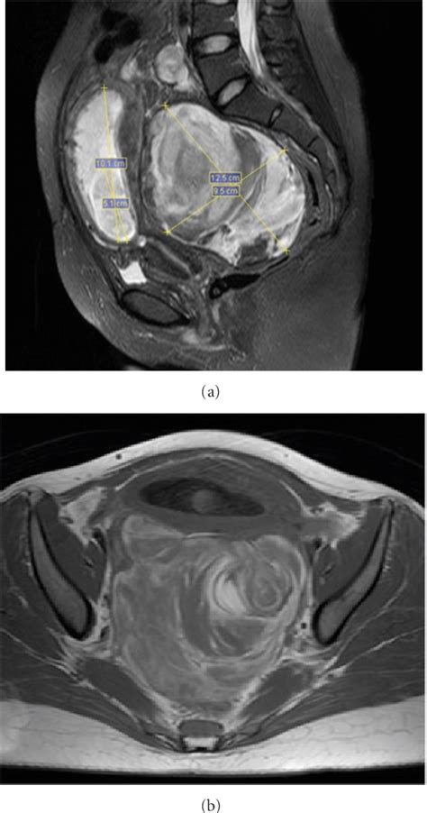 Figure From Diagnosis Of Heterotopic Pregnancy Using Ultrasound And