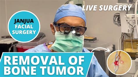 Bone Tumor Osteoma Removal Live Surgery Dr Tanveer Janjua New