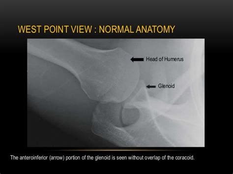 Radiographic Evaluation Of Shoulder