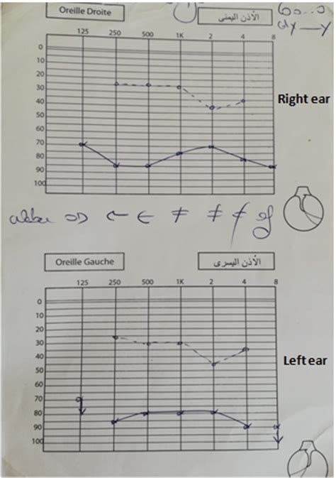 Pure Tone Audiometry Quantifying The Hearing Loss Download