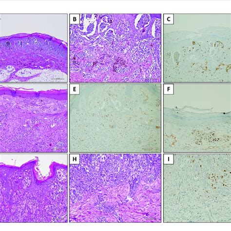 Prame Immunostaining In Three Explicative Lesions Case 1 Spitz Download Scientific Diagram