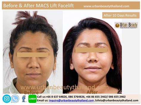 MACS Lift Facelift Thailand Urban Beauty Thailand