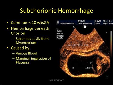 12 Placenta Imaging Dr Ahmed Esawy