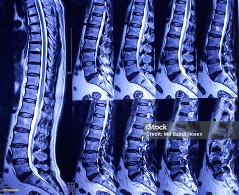 Mri Of Lumbo Sacral Spine L4l5 And L5s1 Level Thecal Sac Indentation ...