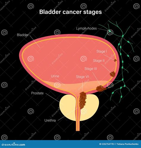 Bladder cancer stages stock vector. Illustration of medical - 226754778