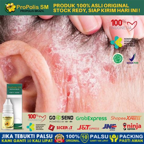 Jual Obat Penghilang Ketombe Basah Kering Obat Ketombe Parah Di