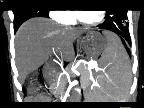 Radiodiagnosis - Imaging is Amazing-Interesting cases: Splenic Artery ...