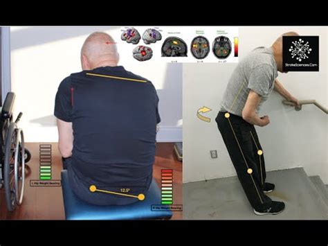 Post Stroke Postural Instability Suboptimal Truncal Control And Fear