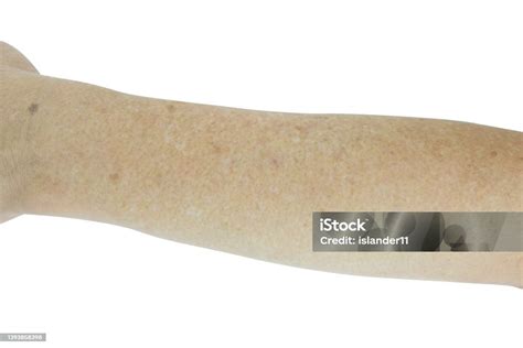 Small White And Brown Spots On The Skin Of Senior Man Arm Isolated On White Background Stock