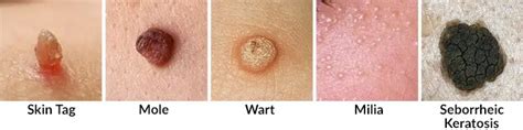 Skin Tags : Causes, Prevention, Removal