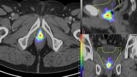 Mapping Technique Improves Decision Making for Prostate Cancer ...