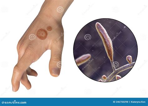 Fungal Infection On A Man S Hand Tinea Manuum And Close Up View Of