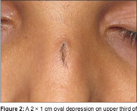 Figure 1 From Nasal Dermoid Sinus Cyst In A Young Female Semantic Scholar