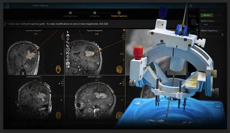 ClearPoint Neuro Announces FDA Clearance Of The SmartFrame Array