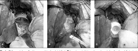 Figure From Results Using Trabecular Metal Augments In Combination