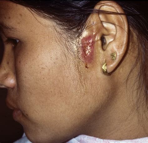 Preauricular Sinus Earaidnepal