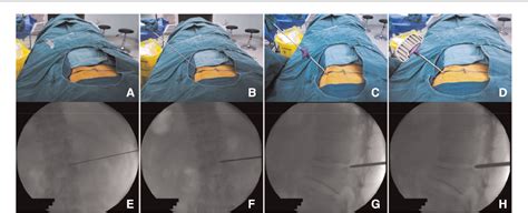 Figure 1 From A Modified Trajectory Of Kyphoplasty Via Superior Pedicle Notch For Osteoporotic