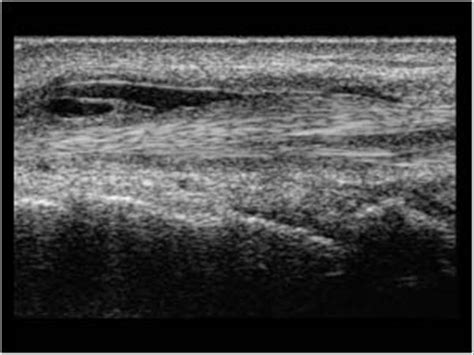 Musculoskeletal Joints and Tendons | 6.3 Wrist and carpus : Case 6.3.3 Tenosynovitis of the ...