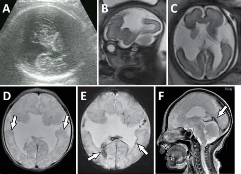 Fetal Porencephaly