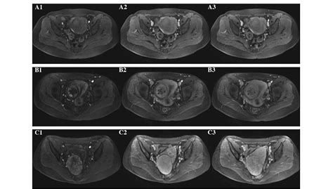 Uterine Fibroids Mri