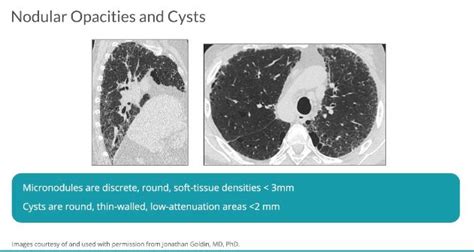 Nodular Opacities Lungs