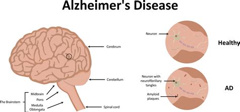 Role Of Tau In Neurodegenerative Diseases Remind