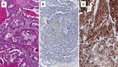 Frontiers New Prostate Cancer Targets For Diagnosis Imaging And Therapy Focus On Prostate