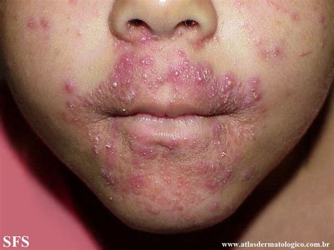 Perioral Dermatitis Nc Commons