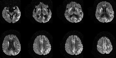 Dr Balaji Anvekar S Neuroradiology Cases Creutzfeldt Jakob Disease MRI