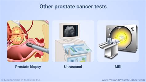 Slide Show Understanding Prostate Cancer