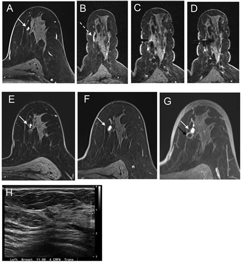 Clinical Outcomes Of Benign Concordant Mri Guided Breast Biopsies Clinical Breast Cancer