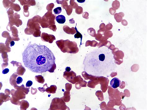 Gaucher S Cells And Peripheral Blood LM Stock Image C009 3463