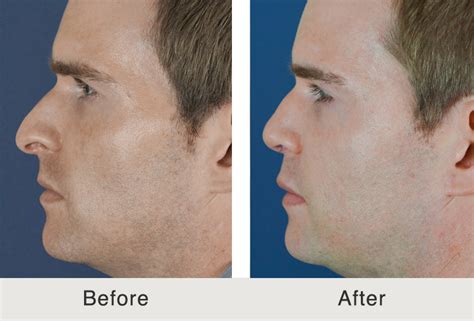 Before After Male Filler Temples And Tear Trough Carolina Facial