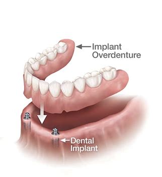 Surgical Dentistry - Implant Retained Denture Carina Brisbane