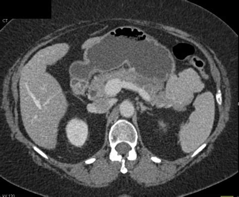 Large Accessory Spleen Spleen Case Studies Ctisus Ct Scanning