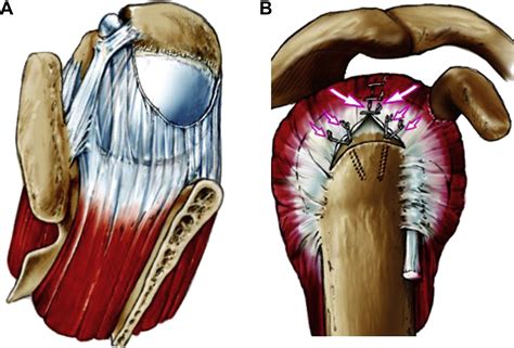 Results Of Arthroscopic Partial Repair Of Large Retracted Rotator Cuff