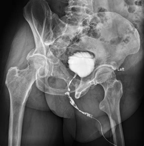Intermittent Catheter Urethral Stricture at Lon Taylor blog