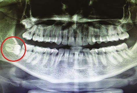 Casi Estrazioni Denti Del Giudizio Inclusi Studi Dentistici Nicola