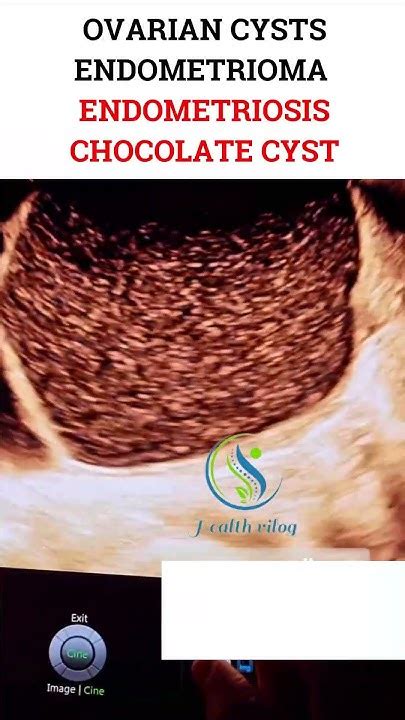 Ovarian Cysts Endometrioma Endometriosis Chocolate Cyst Pregnancy