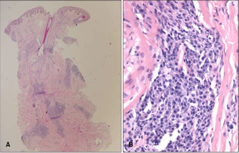 A Dense Perivascular And Periadnexal Mature Plasma Cells Infiltrate Download Scientific