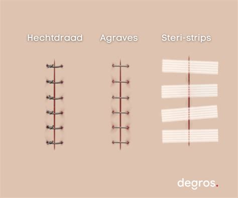 Alles Over Hechten En Wondsluiting Technieken Materialen Tips Degros