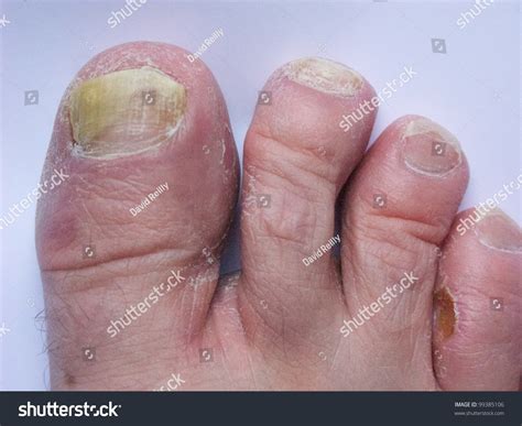 Athlete'S Foot Stock Photo 99385106 : Shutterstock