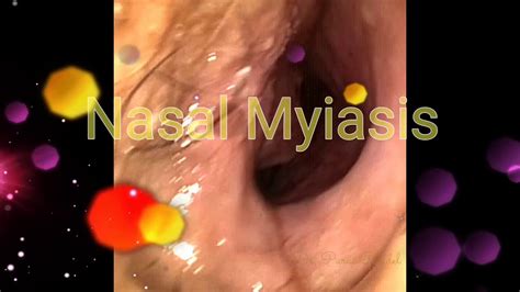 Maggots in human nose-Nasal myiasis - YouTube