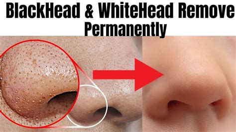 How To Remove Blackheads From Nose And Face Just 5 Mints Best Way To