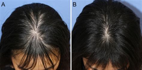 Rapidly Progressive Hair Loss May Be The Only Sign Of Syphilis The