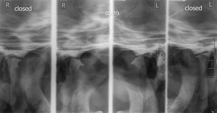 Osteoarthritis Of The Temporomandibular Joint Radiology Reference