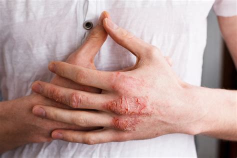 Eczema On Hands Types