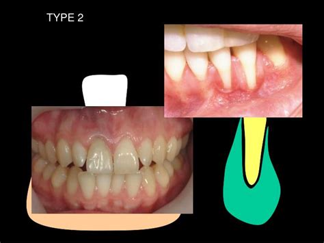 Ppt Periodontal Aesthetics Powerpoint Presentation Id 4890149