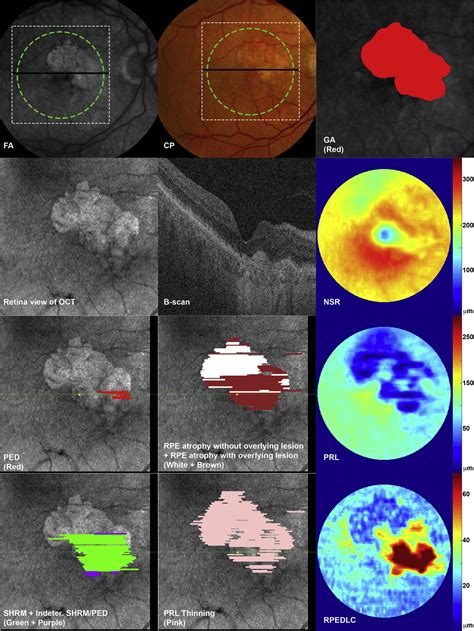 Distribution Of Oct Features Within Areas Of Macular Atrophy Or Scar