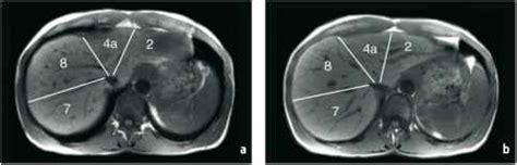 Liver Segments MRI